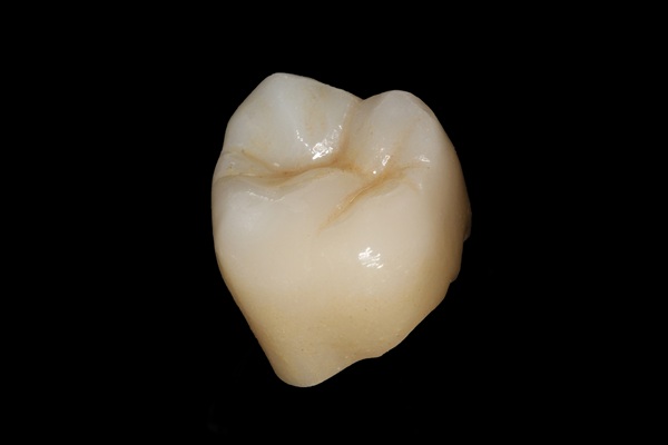 The Average Longevity Of Dental Crowns