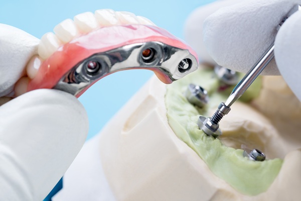 Things To Know About Implant Supported Dentures